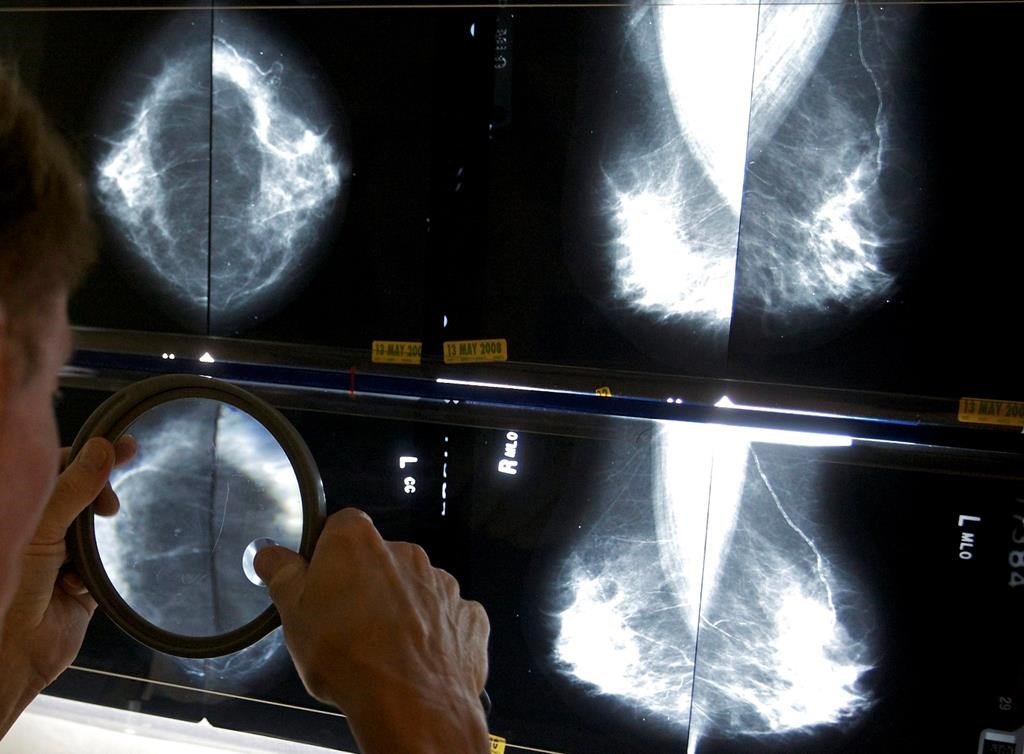 Breast cancer: Free screening has now been expanded to include Quebec women aged 70 to 74 years