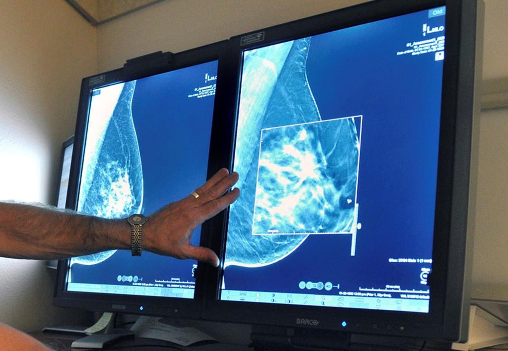 Early detection of breast cancer can save millions of people